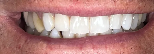 veneers after photo